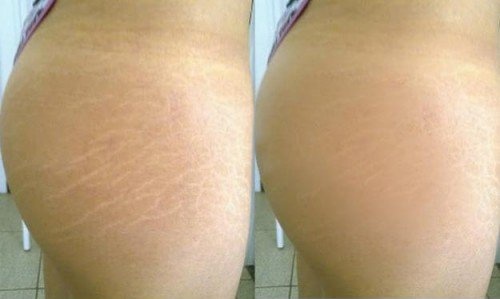 cicatricure stretch mark cream