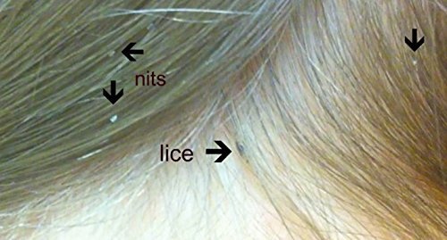 New Mata Piojos Head Hair Genital Pubic Body Lice Crabs Nits