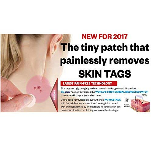 32++ Biodermal skin tag patches